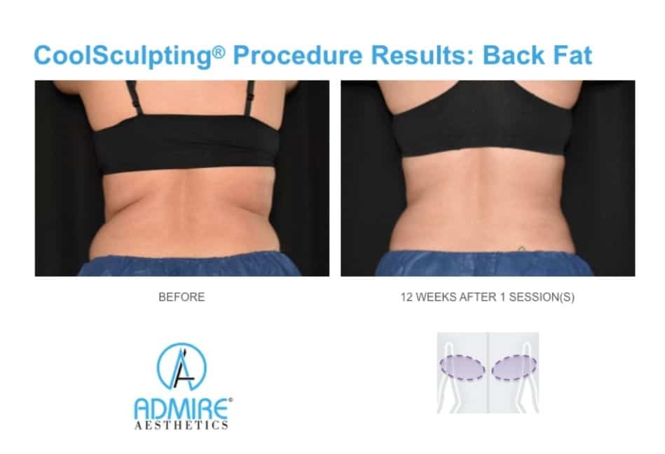 CoolSculpting for Bra & Back Fat - Benefits, Costs, Results
