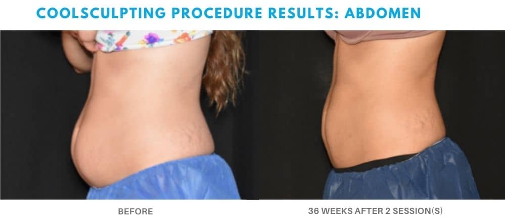 CoolSculpting Stomach Medford OR