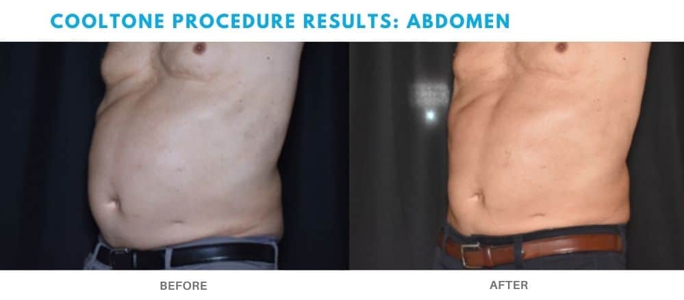 CoolTone: The Exciting, New Nonsurgical Muscle Toning Procedure
