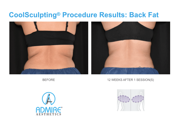 CoolSculpting Back Fat - Before & After, Reviews, Cost