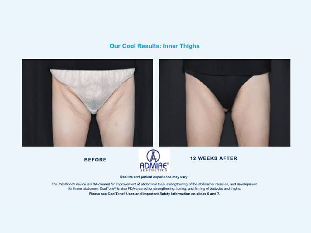 Coolsculpting Before and After - 7