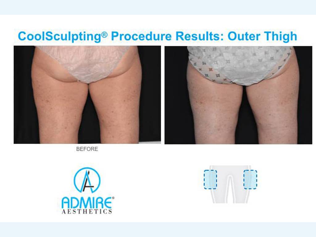 Coolsculpting Before and After - 8