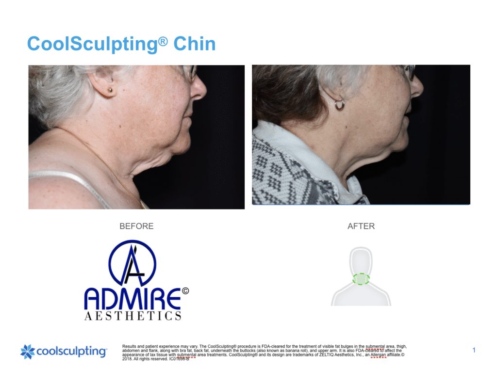 Womans-submental-chin-before-and-after-coolsculpting-treatment-at-Admire-Aesthetics-Medford-OR-17-1024x763_11zon