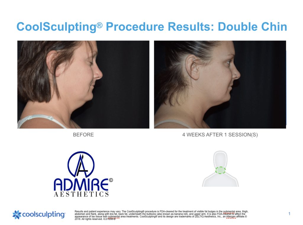 Womans-submental-chin-before-and-after-coolsculpting-treatment-at-Admire-Aesthetics-Medford-OR-18-1024x761_11zon