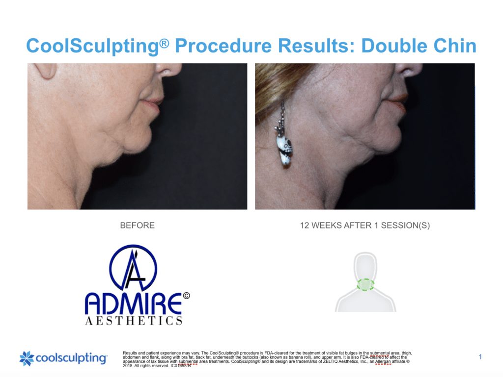 Womans-submental-chin-before-and-after-coolsculpting-treatment-at-Admire-Aesthetics-Medford-OR-20-1024x769_11zon