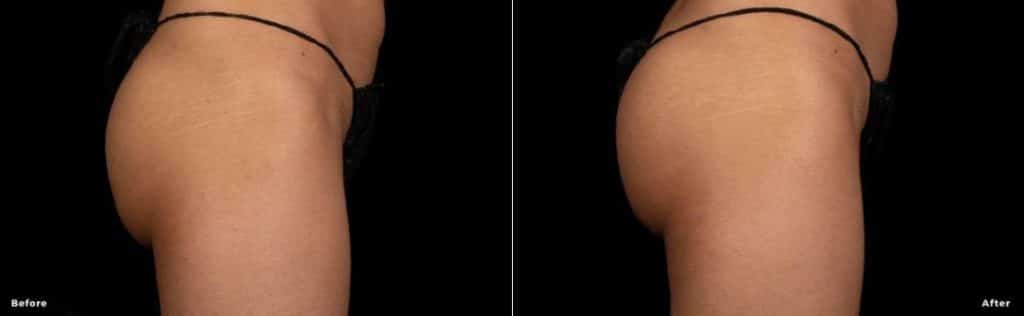 Buttocks before and after treatment.