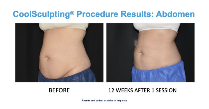 CoolSculpting Elite, reducing fat to sculpt her waist, before and
