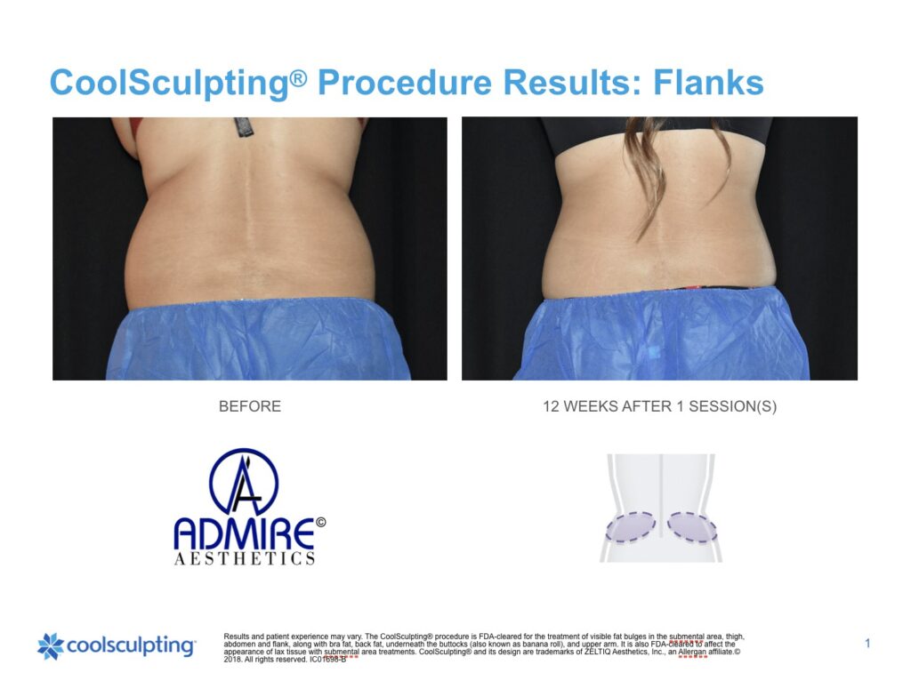 Womans back flanks before and after Coolsculpting treatment at Admire Aesthetics.